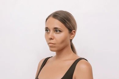 Buccal Fat Removal